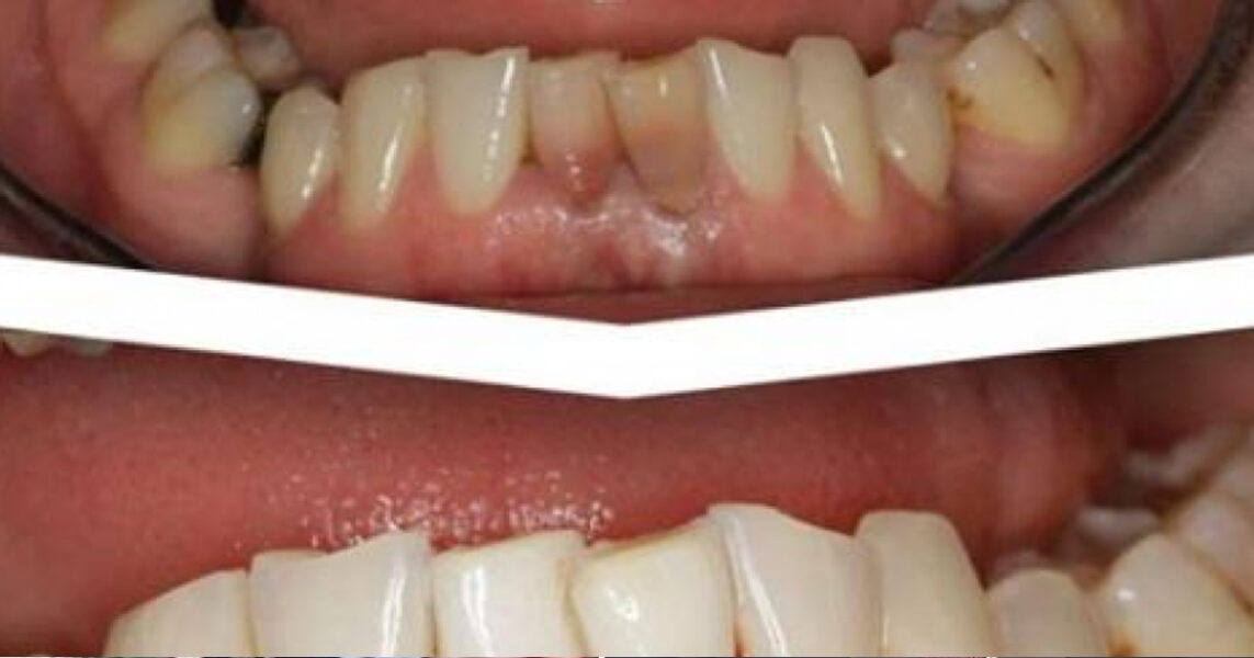 Pastroni dhëmbët me këtë përbërës dhe mos shkoni më tek dentisti