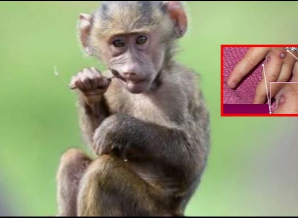 Masa për lijën e majmunëve/ Ministria e Shëndetësisë tregon nëse ka pasur raste infeksioni